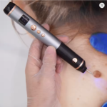 Electric Plasma Pen Facial Tag Removal Painless Skin Eraser Mole Pen Efficient Electrocautery Wart Papilloma - Image 2
