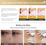 Electric Plasma Pen Facial Tag Removal Painless Skin Eraser Mole Pen Efficient Electrocautery Wart Papilloma - Image 5